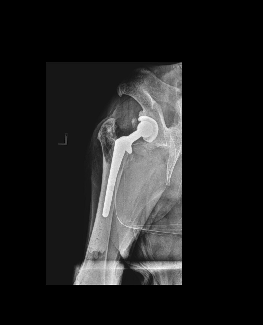 Radiografía de una articulación de la cadera.